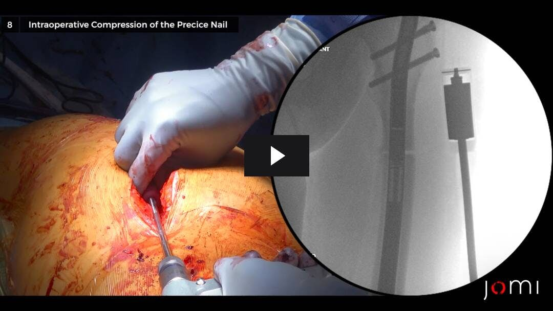 Video preload image for The Use of a Magnetic Intramedullary Nail for Management of a Symptomatic Nonunion Following Shortening Osteotomy to Treat Leg-Length Discrepancy