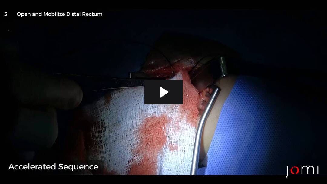 Video preload image for Posterior Sagittal Anorectoplasty (PSARP) for Imperforate Anus