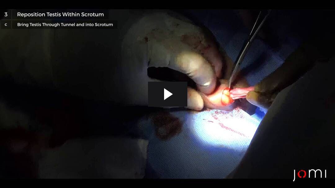 Video preload image for Orquiopexia y circuncisión