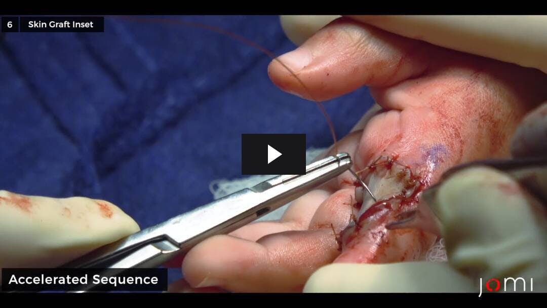 Video preload image for Contracture Release and Full-Thickness Skin Graft to Volar Index Finger with K-Wire Insertion