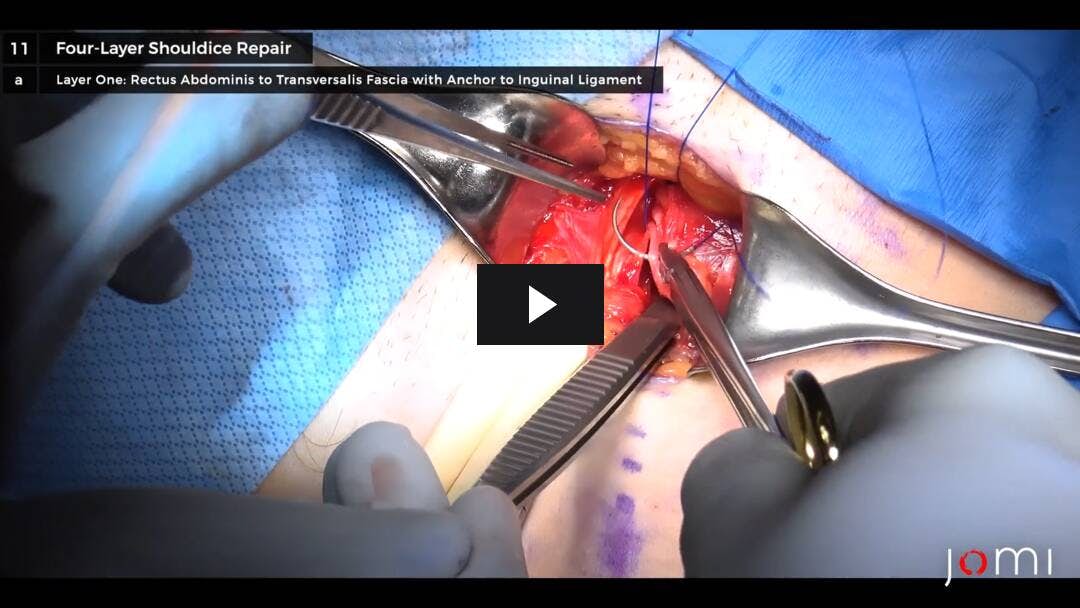 Video preload image for Shouldice Repair for Left Direct Inguinal Hernia