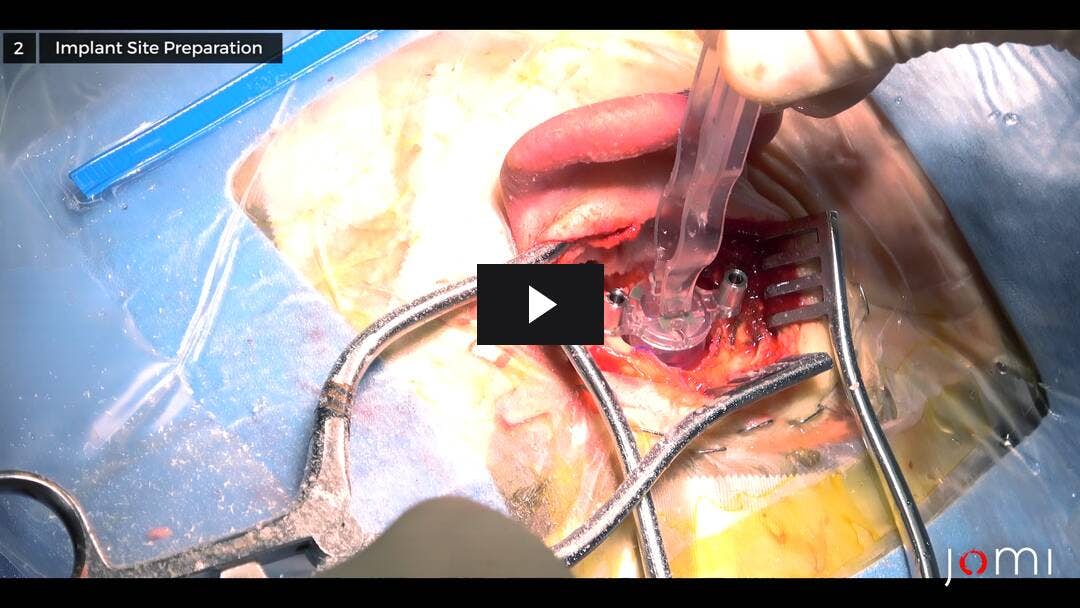Video preload image for Bonebridge Implant