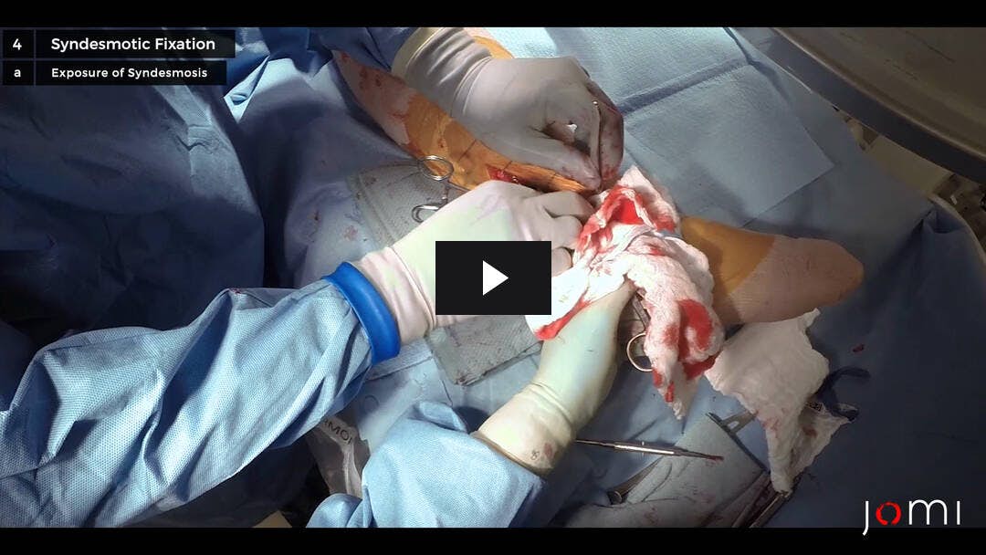 Video preload image for Reducción abierta y fijación interna de una fractura trimalleolar de tobillo
