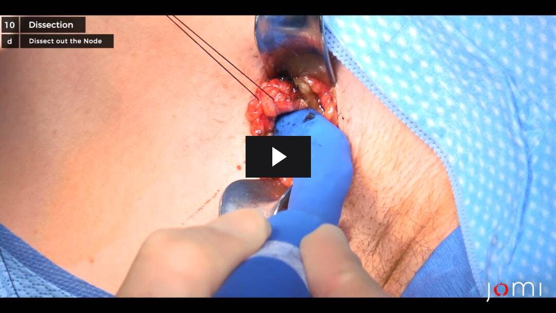 Video preload image for Wide Local Excision of an Intermediate-Thickness Back Melanoma with a Sentinel Lymph Node Biopsy of Left Axillary Lymph Nodes