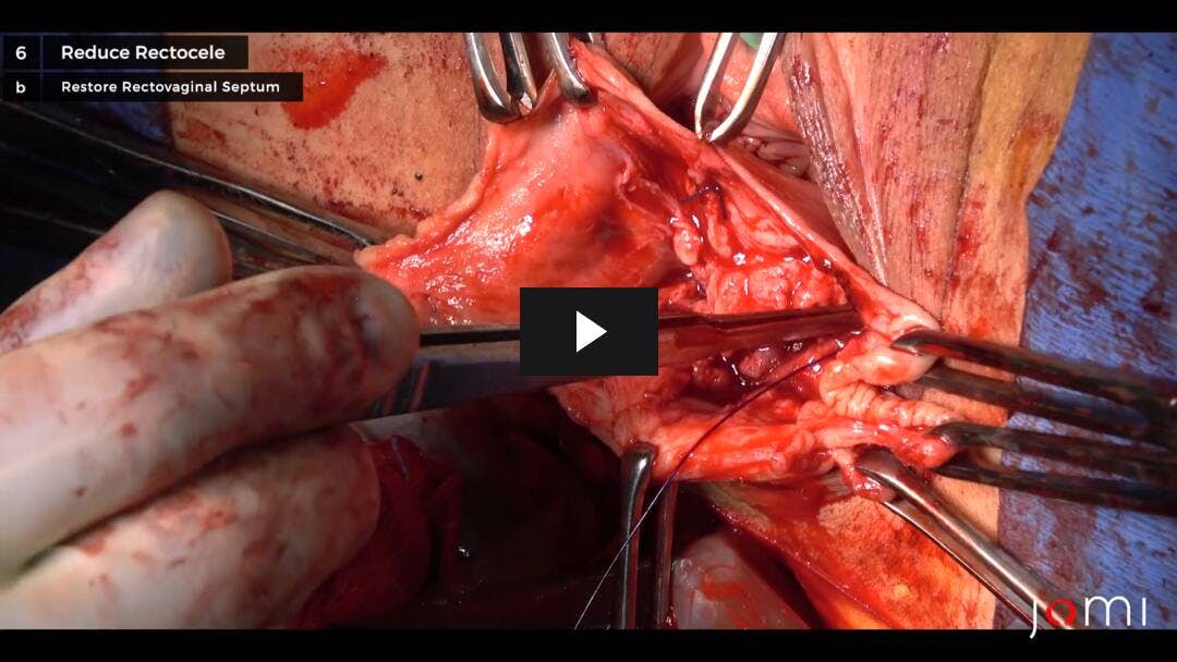 Video preload image for Colporrafia posterior específica del sitio y perineorrafia para el rectocele