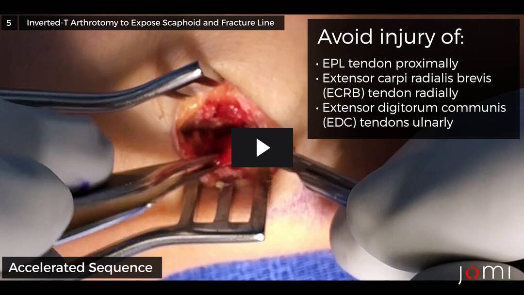 Video preload image for Scaphoid Open Reduction and Internal Fixation Through Dorsal Approach