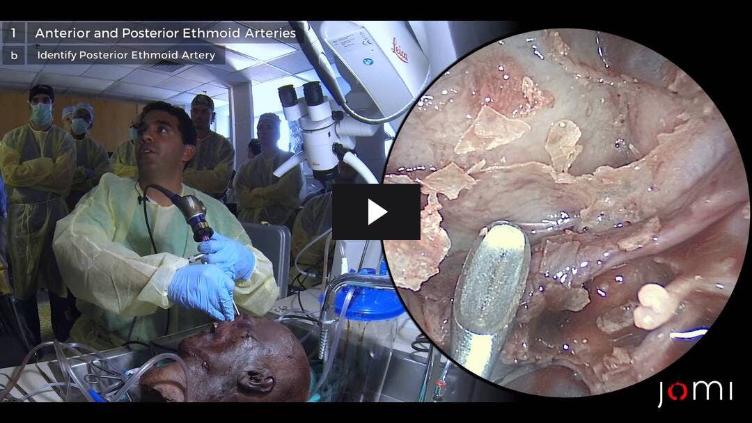 Video preload image for Ethmoid Artery Anatomy