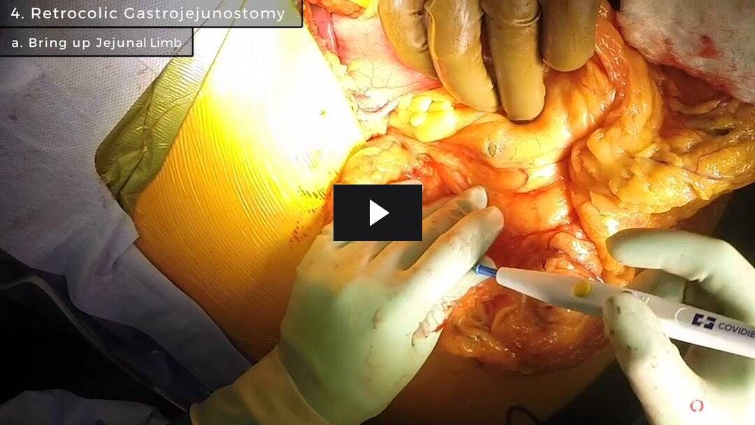 Video preload image for Open Antrectomy, Duodenal Resection, and Gastrojejunostomy for a Multiple Endocrine Neoplasia Tumor