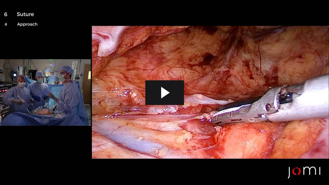 Video preload image for Rectopexia de sutura laparoscópica conculdoplastia, reparación de la pared vaginal y perineorrafia para el prolapso rectal