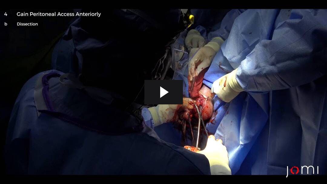 Video preload image for Histerectomía vaginal, suspensión del ligamento uterosacro y escisión de tejido vaginal redundante