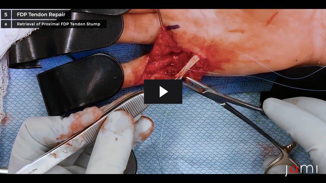 Video preload image for Reparación del tendón flexor para una laceración del tendón FDP de zona 2