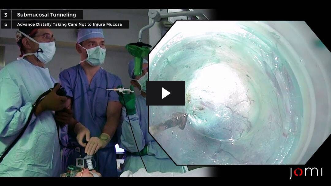 Video preload image for Peroral Endoscopic Myotomy (POEM) for Achalasia