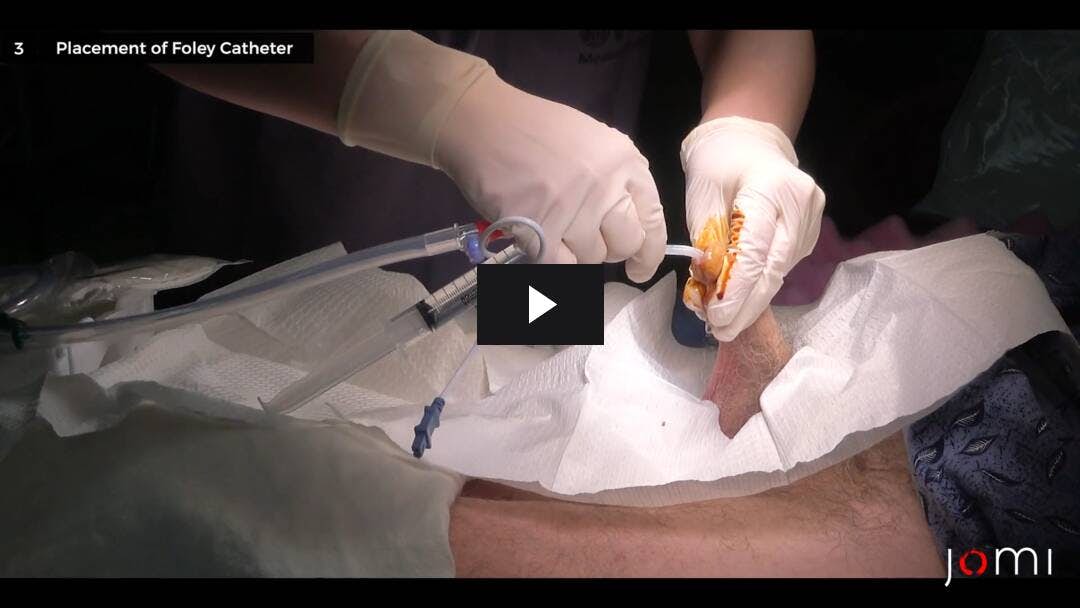 Video preload image for Foley Catheter Placement: Indications, Maintenance, Complications, and Demonstration on a Preoperative Male Patient
