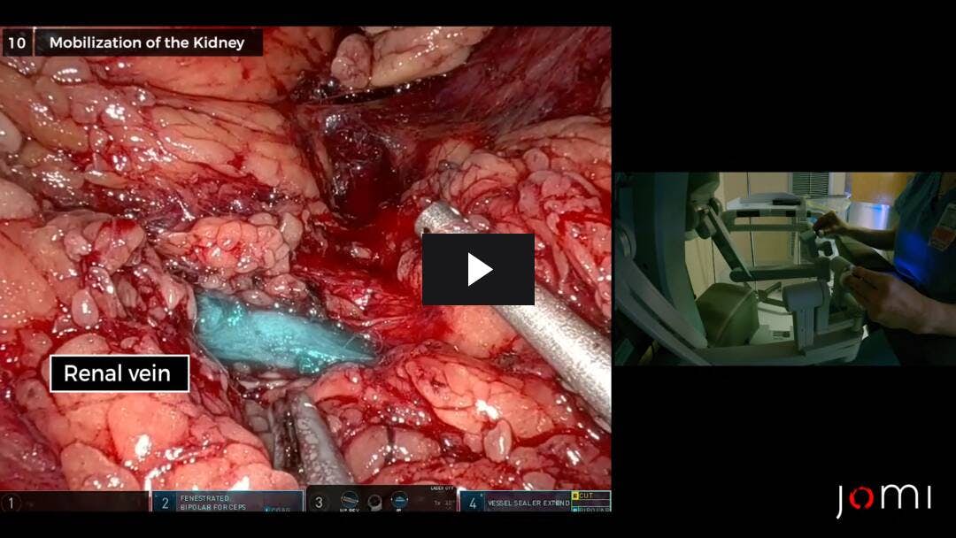 Video preload image for Robotic-Assisted Laparoscopic Left Donor Nephrectomy for Living Kidney Donation