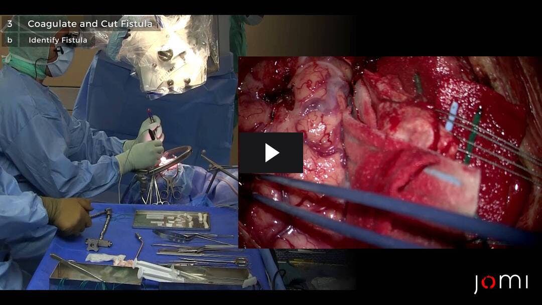 Video preload image for Mikrochirurgische Resektion einer intrakraniellen duralen arteriovenösen Fistel