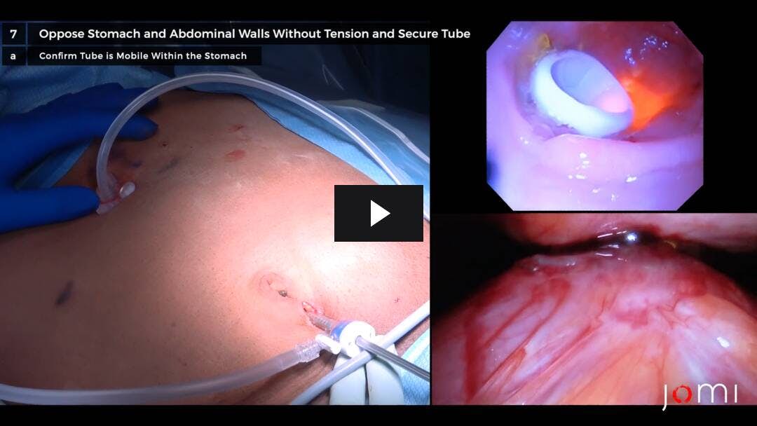 Video preload image for Laparoscopic-Assisted Percutaneous Endoscopic Gastrostomy (PEG) Tube Placement