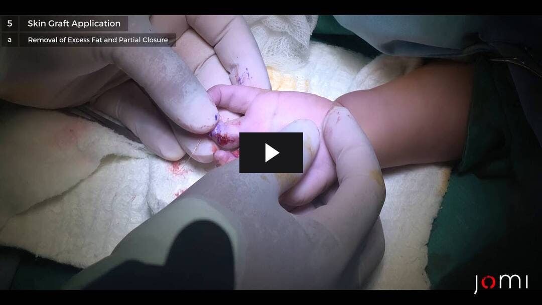 Video preload image for द्विपक्षीय Syndactyly तीसरी और चौथी उंगलियों की रिहाई