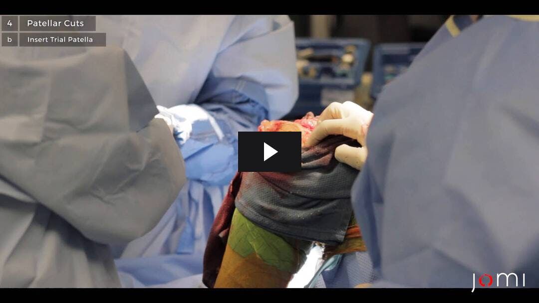 Video preload image for Artroplastia total de rodilla que retiene el cruzado posterior