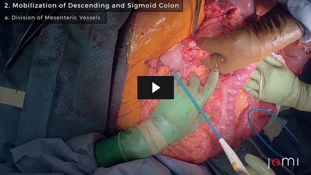 Video preload image for Colectomía izquierda abierta para el cáncer de colon: resección de colon izquierdo y sigmoide con formación de colostomía