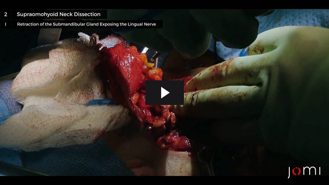 Video preload image for Behandlung des Plattenepithelkarzinoms aus dem hinteren Oberkiefer mit Obturatorplatzierung und ipsilateraler Halsdissektion