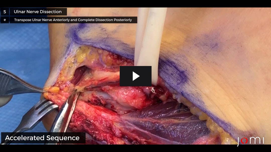 Video preload image for Transposición subcutánea del nervio cubital