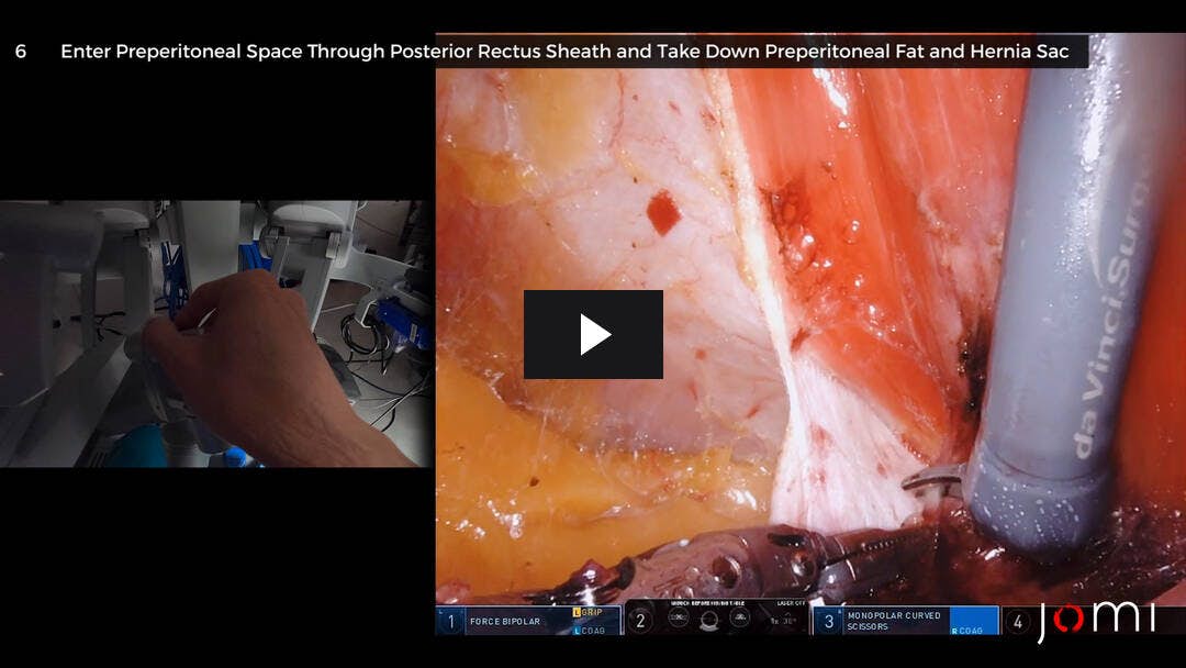 Video preload image for 腹側ヘルニアに対するロボット式eTEP後直腸裂-ストップパ修復