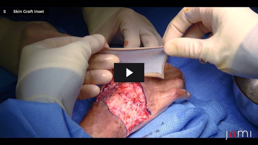 Video preload image for Split-Thickness Skin Graft for Scar Release, Permanent Pigment Transfer, and Fractional CO2 Laser Therapy