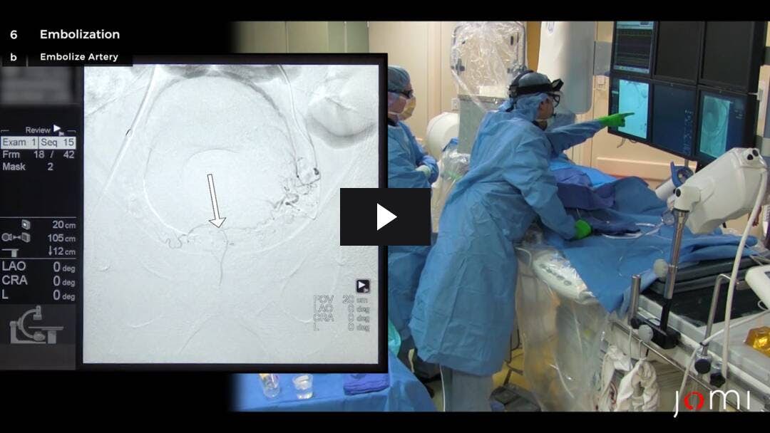 Video preload image for Prostatic Artery Embolization (PAE)