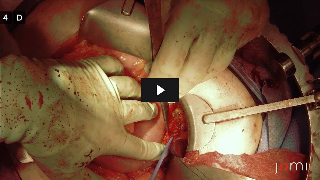 Video preload image for Whipple Procedure for Carcinoma of the Pancreas - Part 2