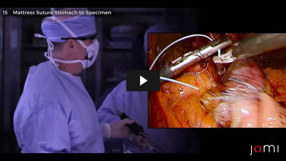Video preload image for Esofagectomía Ivor Lewis mínimamente invasiva