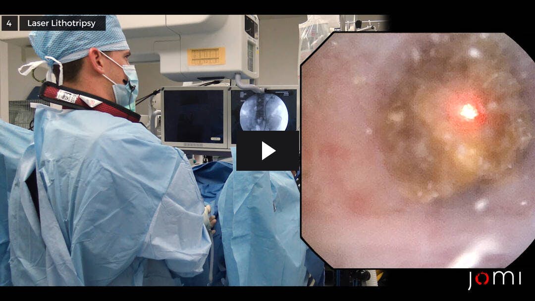 Video preload image for Ureteroscopia, litotricia láser y reemplazo de stent para una piedra ureteral proximal izquierda que obstruye con ruptura forniceal