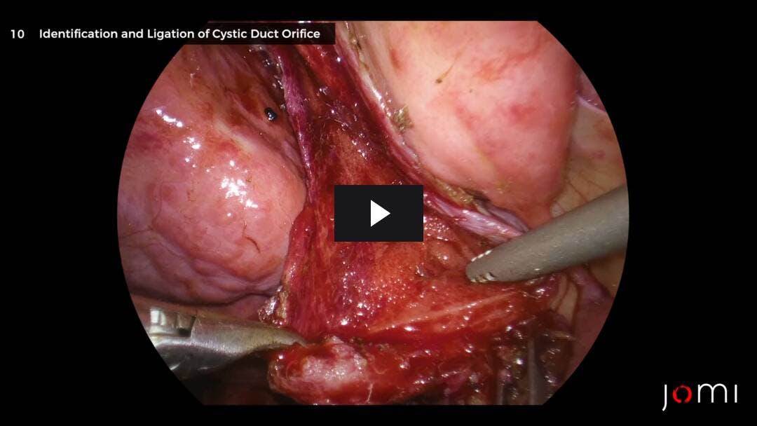 Video preload image for Laparoscopic Subtotal Fenestrating Cholecystectomy in a Cirrhotic Patient