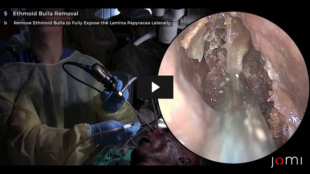 Video preload image for 기능성 내시경 부비동 수술 (사체) : 상악, 사골, 접형골