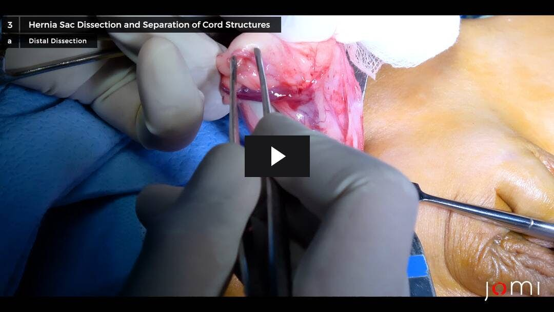 Video preload image for Reparación de hernia inguinal derecha en un niño de 1 año durante una misión quirúrgica