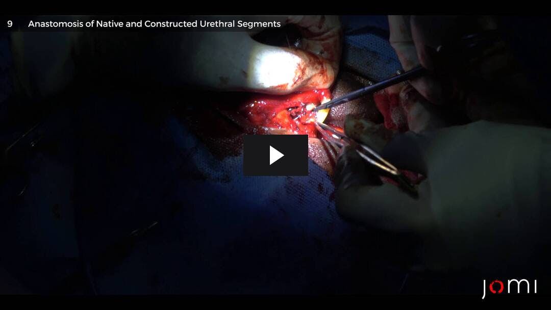 Video preload image for Penoscrotal Hypospadie Reparatur