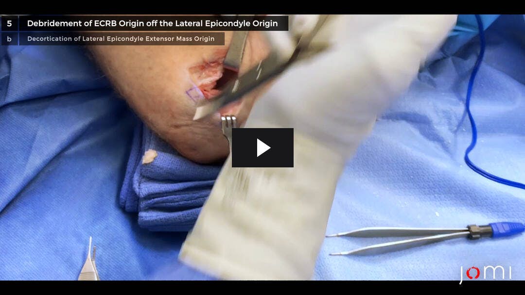 Video preload image for Lateral Epicondylitis Debridement