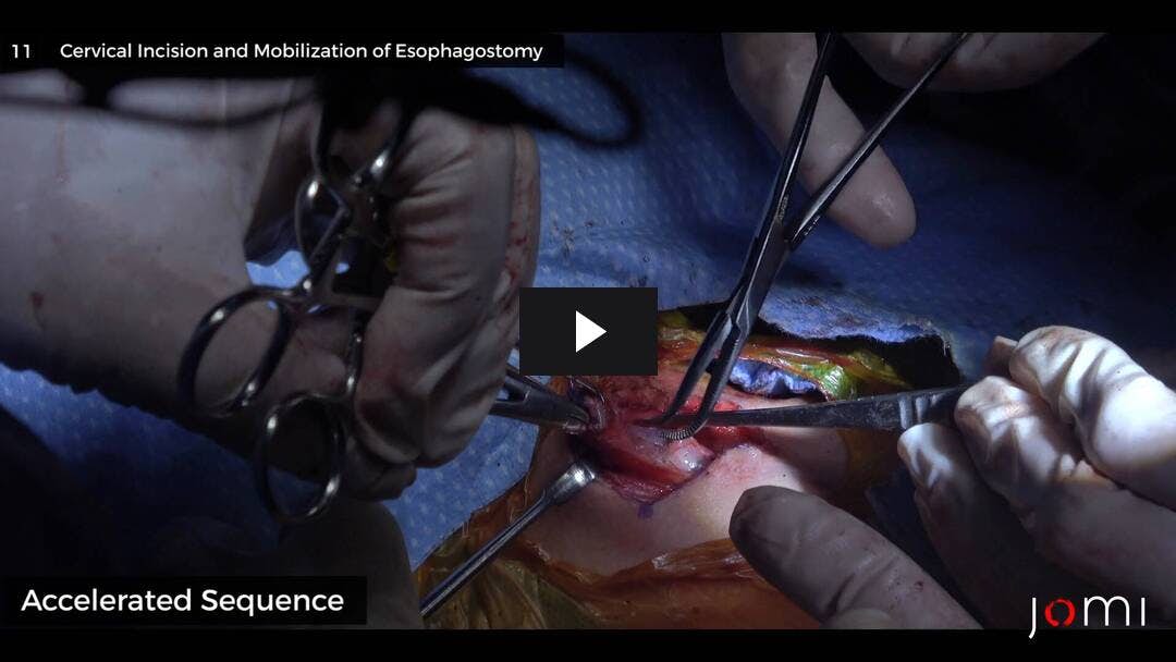 Video preload image for Colonic Interposition for Esophageal Atresia