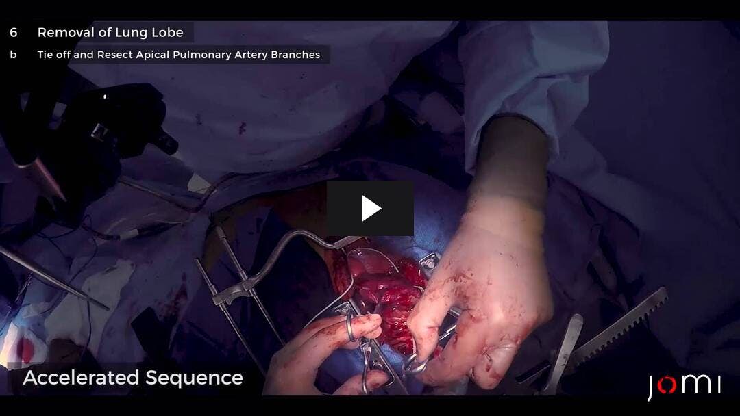 Video preload image for Open Lobectomy