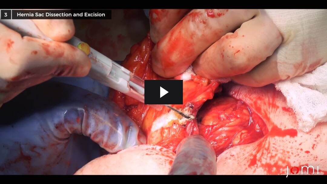 Video preload image for Anterior Component Separation for Multiple Incisional Hernias Along an Upper Midline Incision