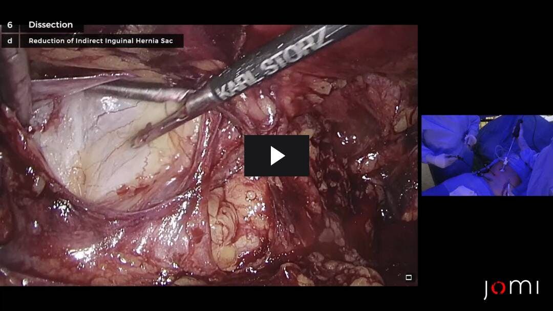 Video preload image for Laparoscopic Totally Extraperitoneal (TEP) Left Indirect Inguinal Hernia Repair with Mesh