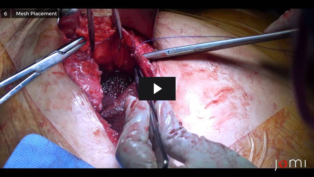 Video preload image for Reparación de malla intraperitoneal para hernia incisional