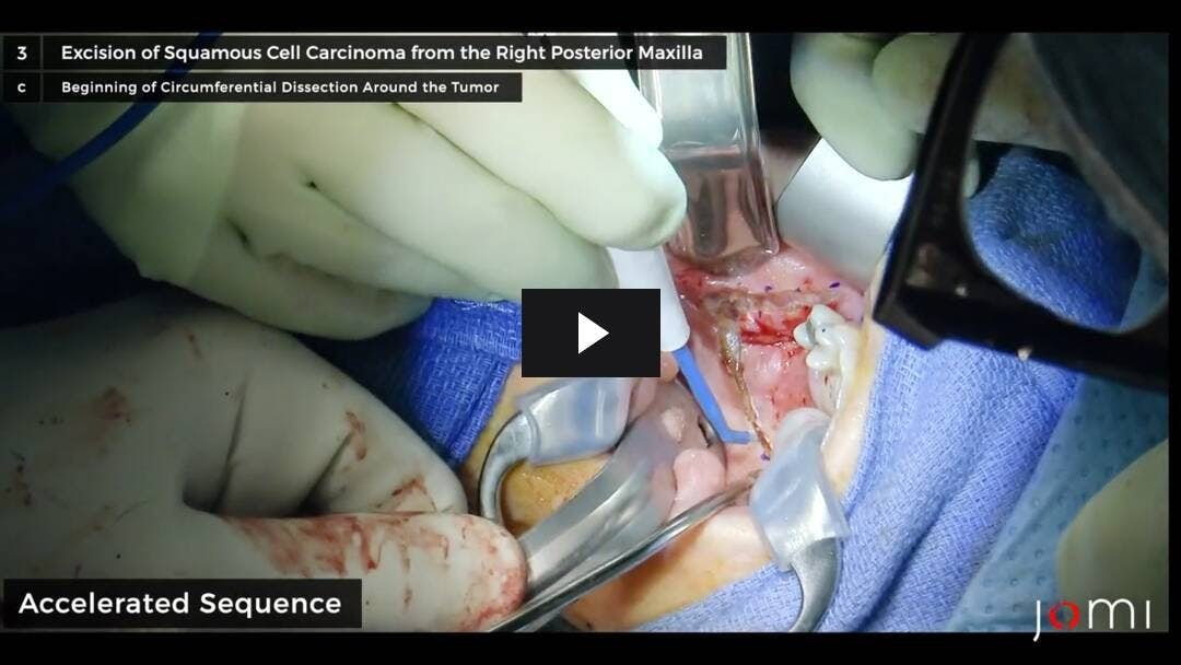 Video preload image for Tratamiento del carcinoma de células escamosas del maxilar superior posterior con escisión local amplia del tumor y alveolectomía total, reconstrucción con avance de la almohadilla de grasa bucal, colocación de un obturador quirúrgico y disección supraomohioidea ipsilateral del cuello