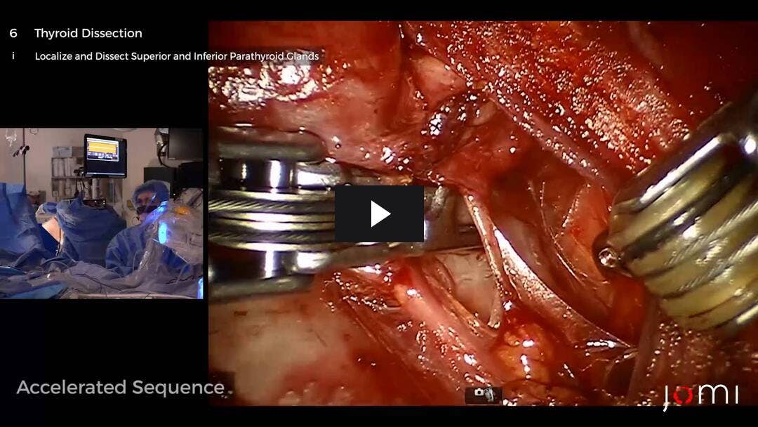 Video preload image for Tiroidectomía robótica: un enfoque bilateral de axilo-mama (BABA)