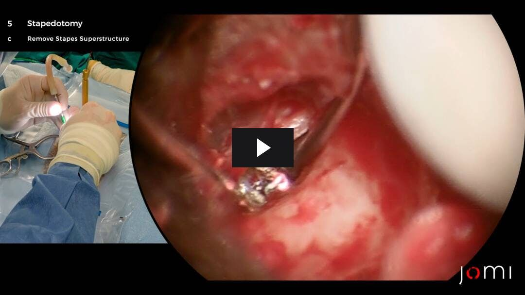 Video preload image for Stapedotomy (Endaural)