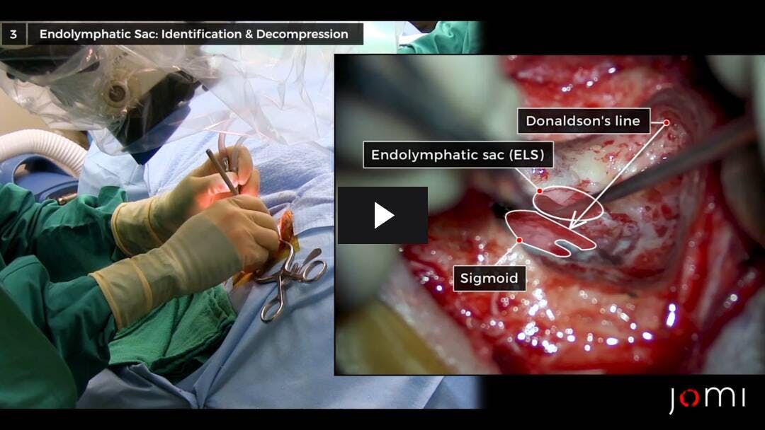 Video preload image for Endolymphatic Sac Decompression