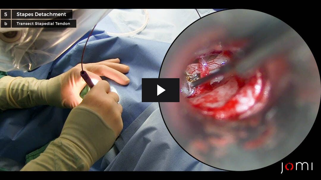 Video preload image for Otoskleroz için Lazer Stapedotomi