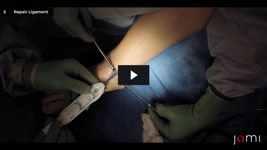 Video preload image for Reparación del ligamento deltoideo