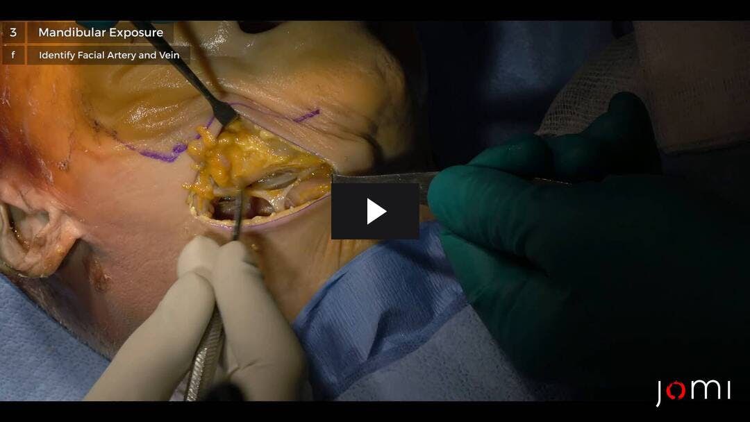 Video preload image for Submandibuläre Annäherung an das Unterkiefer (Cadaver)
