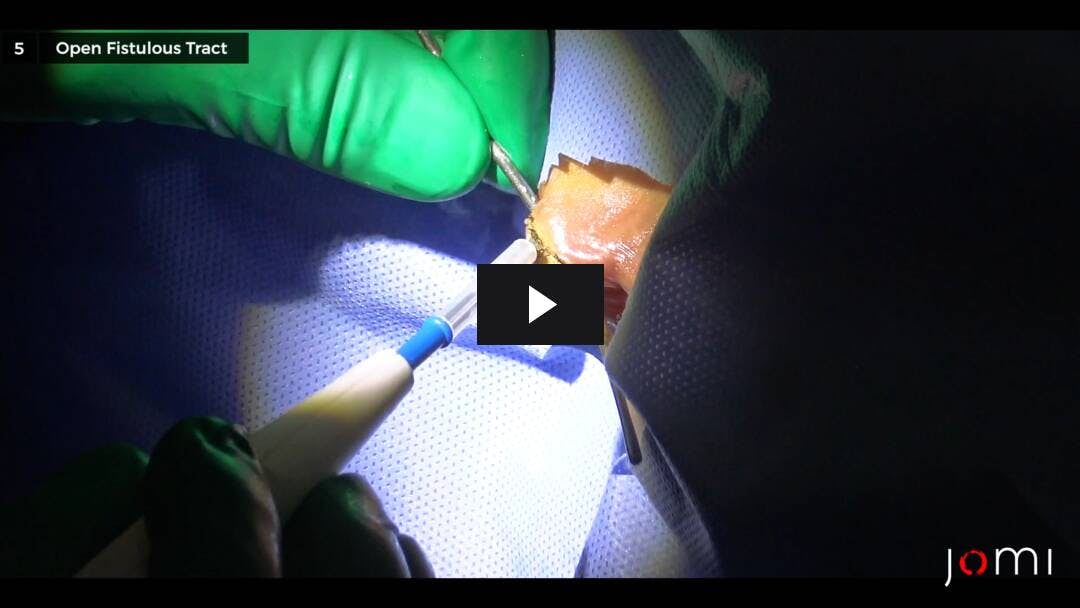 Video preload image for Anal Fistulotomy