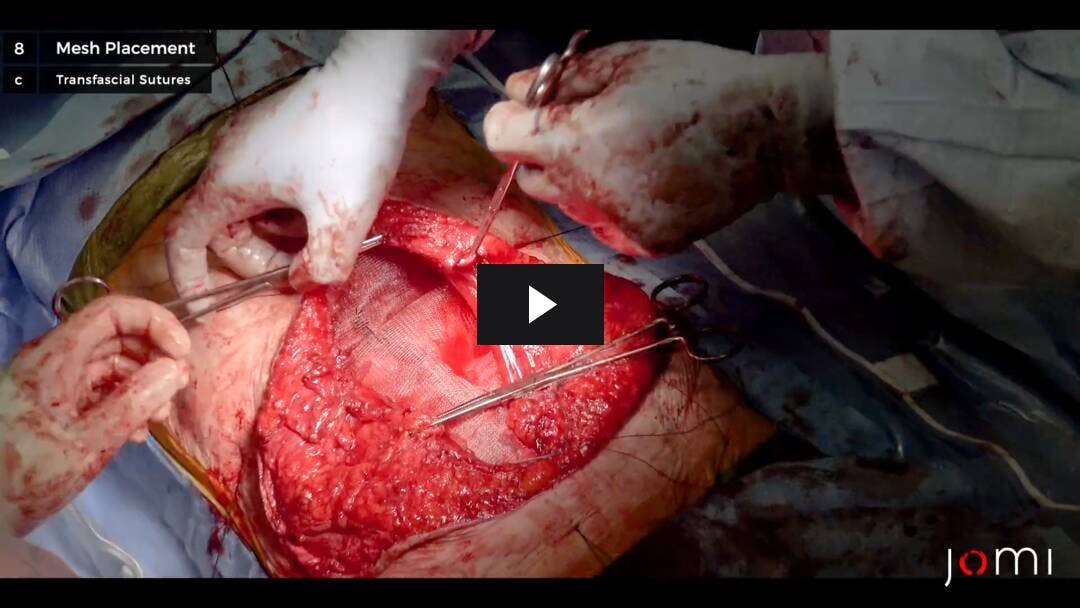 Video preload image for Reparación retromuscular de Rives-Stoppa para la hernia incisional